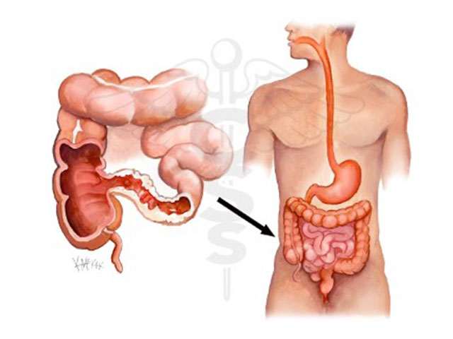 balantia articles nosos crohn elkwdhs kolitida probiotika 01