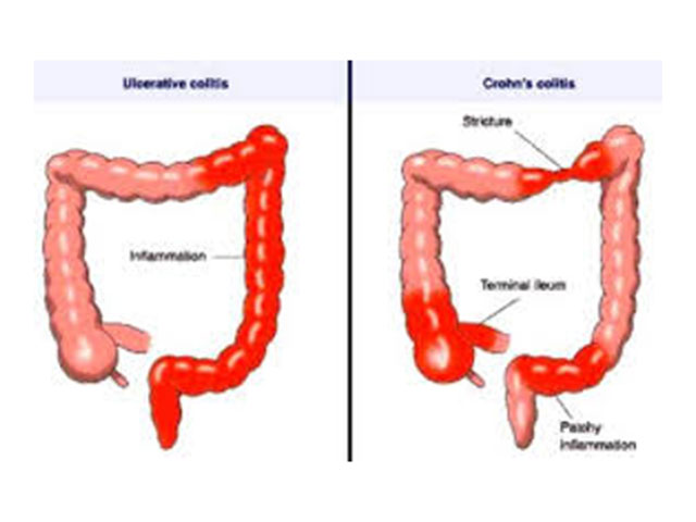 balantia articles nosos crohn elkwdhs kolitida probiotika 02